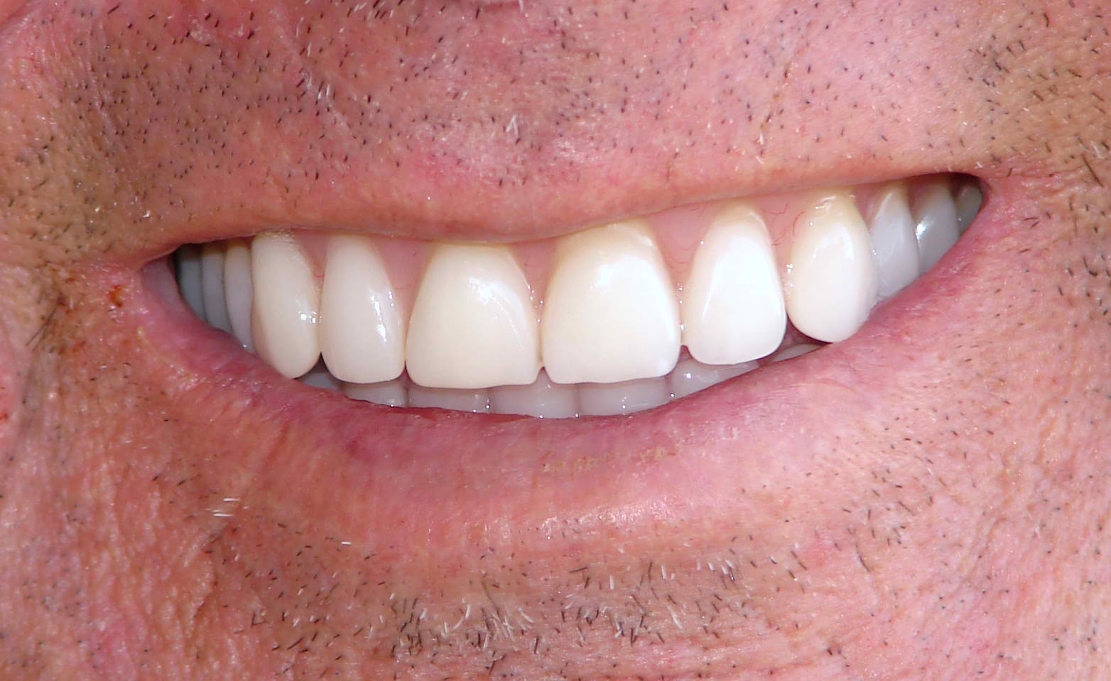 Should You Choose Dental Implants or Dentures? | St. Lawrence Dentistry
