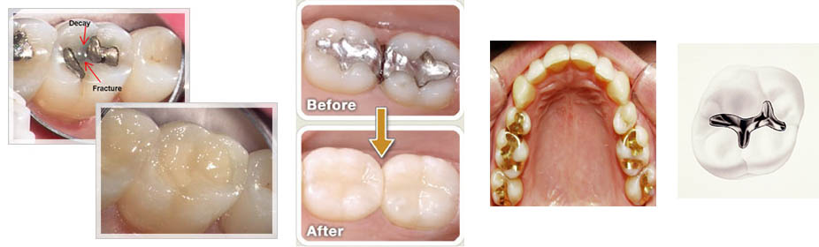 Different-materials-used-as-dental-fillings.jpg