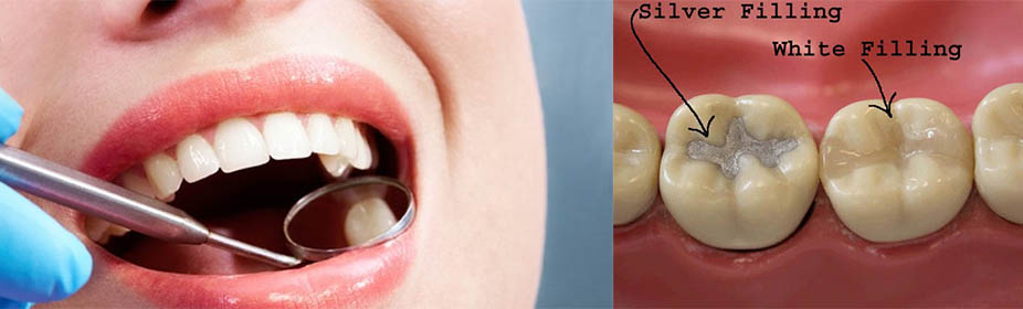 Importance of Dental Fillings -- Dental Inlays and Onlays