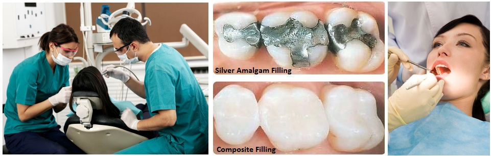 amalgam vs comosite -- cosmetic dentist Mississauga