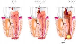 tooth decay -- dental clinic Mississauga