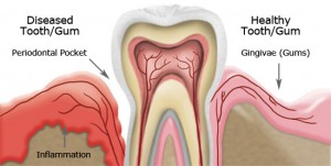 periodontal gum vs. healthy gum