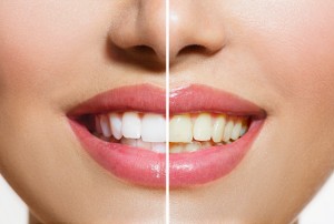 tooth discolouration treatment mississauga