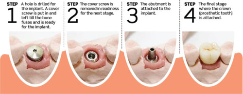 dental implants treatment 