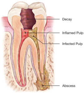 root canal treatment mississauga