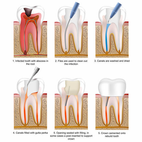 root canal treatment procedure