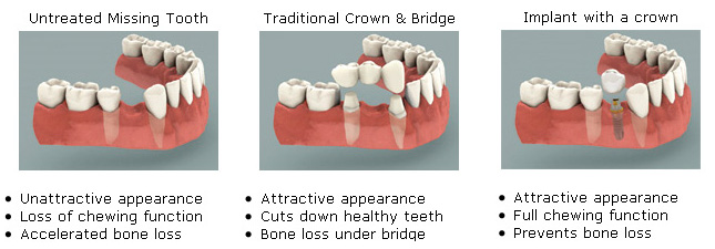 dental implants the best treatment option