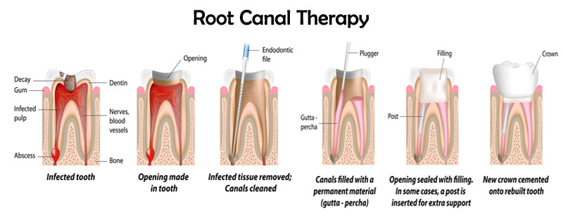 root canal therapy mississauga