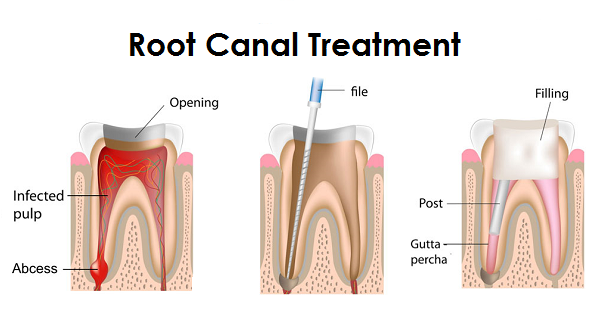 root canal treatment port credit