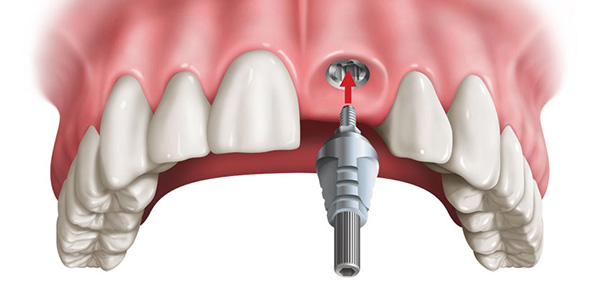 dental implants mississauga