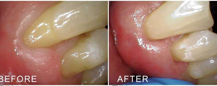 before and after the pinhole procedure