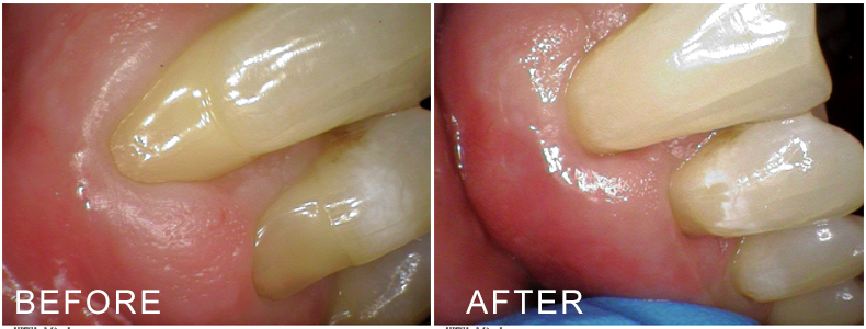 before and after the pinhole procedure