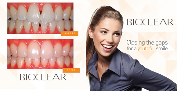 closing the gap cosmetic dental bonding