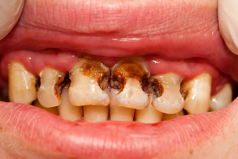 a damaged teeth