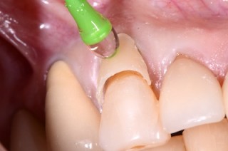 dental erosion treatment
