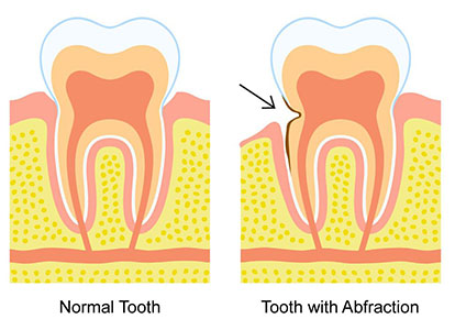 dental erosion treatment mississauga