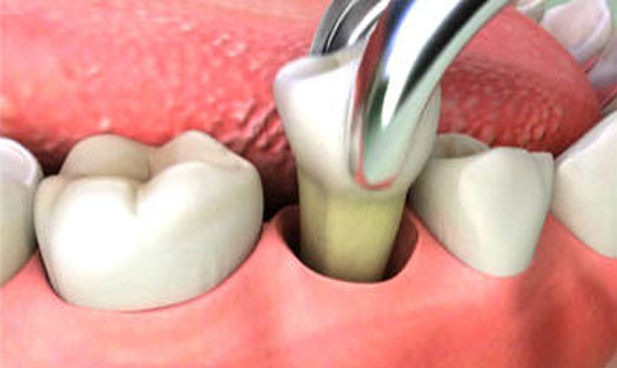 tooth extraction