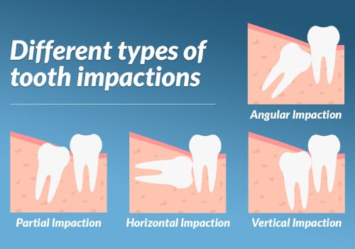 impacted wisdom teeth