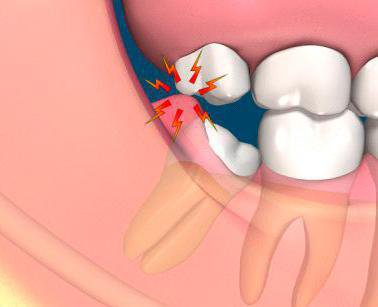 erupting wisdom tooth