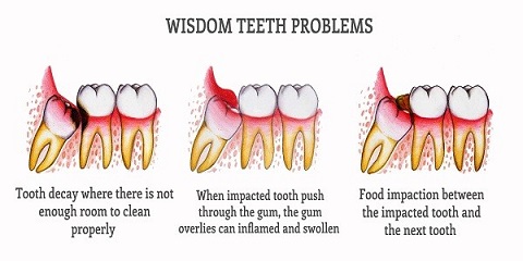 wisdom teeth problems