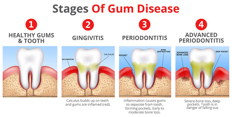 stages of gum disease