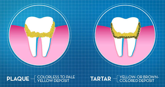 plaque tartar cleaning mississauga