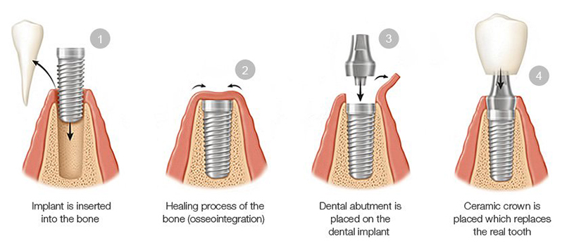 dental implants mississauga