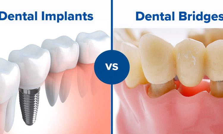 dental bridges vs. dental implants