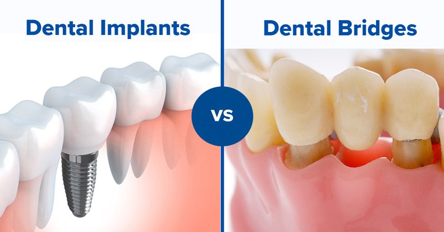 dental bridges vs. dental implants