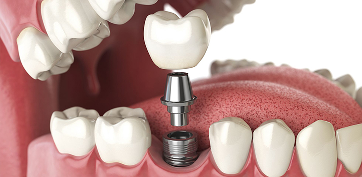 cosmetic dental implants