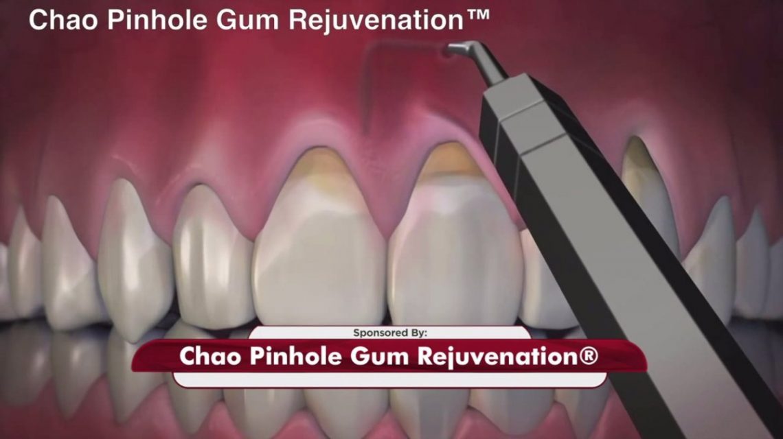 pinhole gum rejuvenation