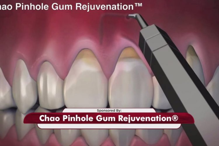pinhole gum rejuvenation