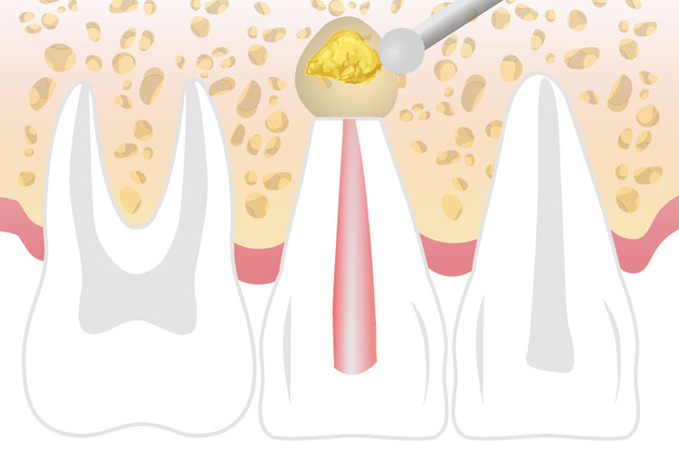 root end procedure of teeth