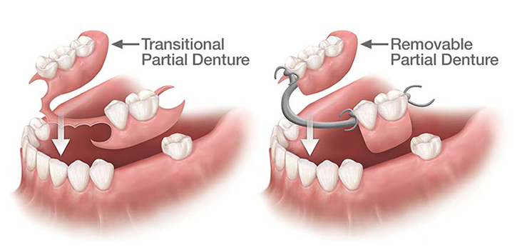 partial dentures mississauga