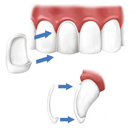 porcelain veneers mississauga