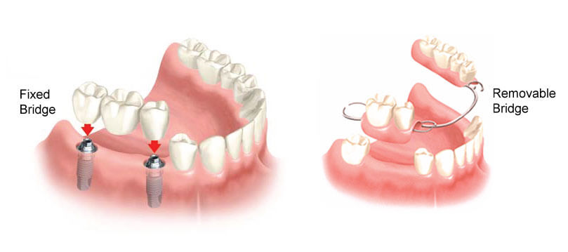 Tooth Bridge