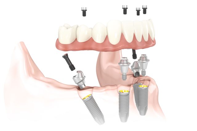 dental implants