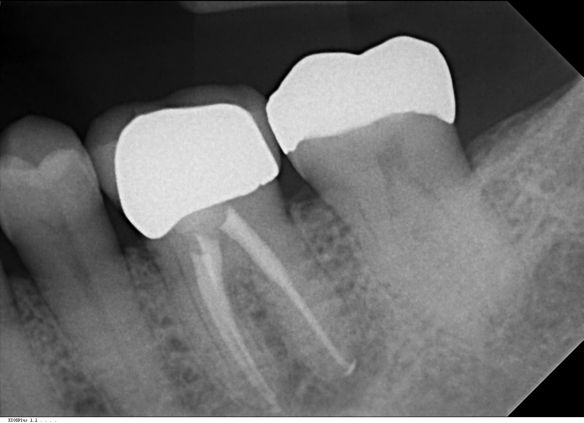 x-ray of completed root canal treatments