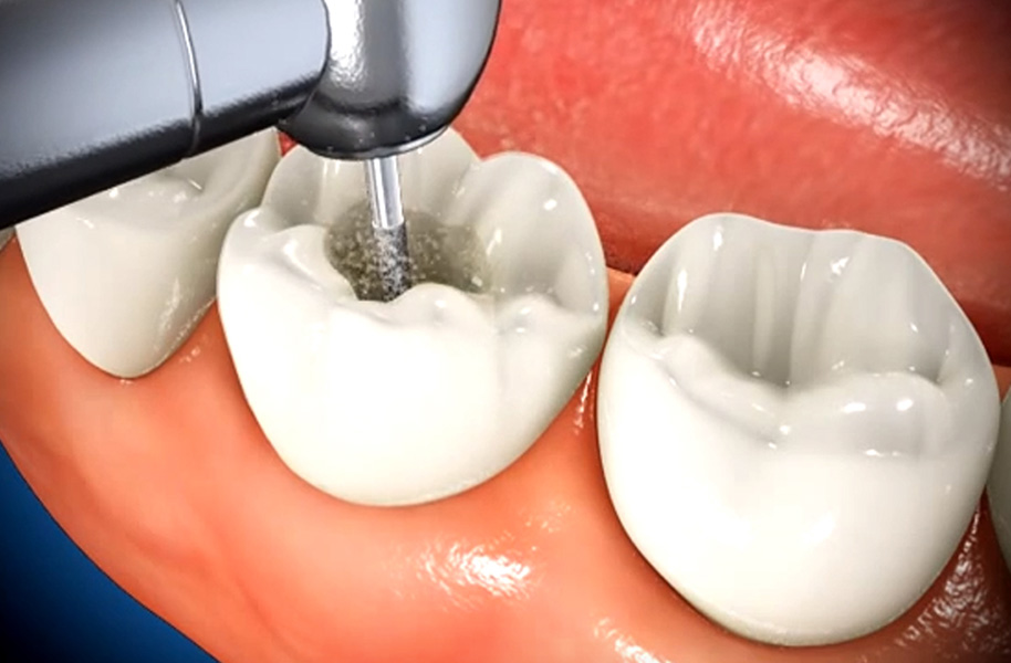 root canal procedure demonstration