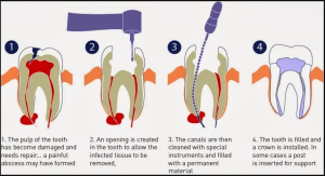 root canal procedure