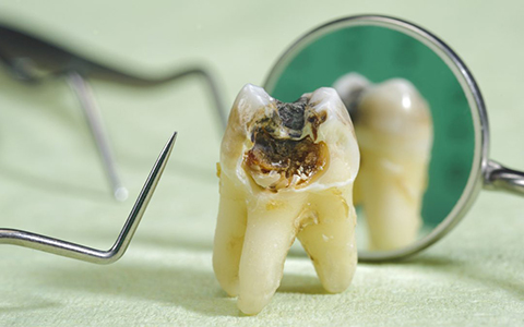 Signs Of A Dead Non Vital Tooth St Lawrence Dentistry