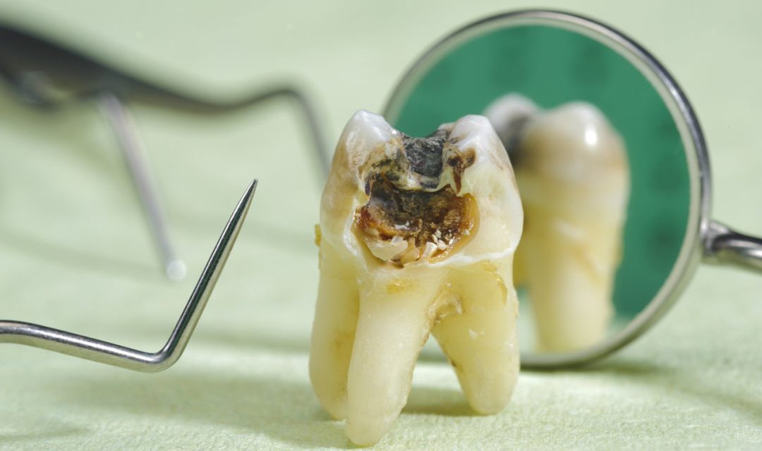 Treatment Of Dead Tooth