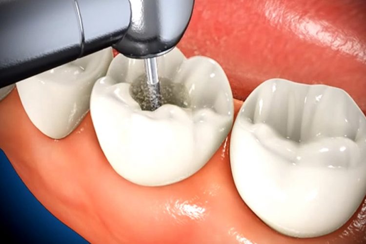 root canal procedure demonstration
