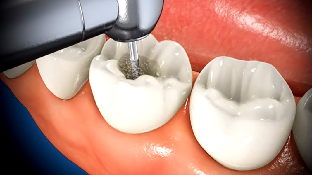 root canal procedure demonstration