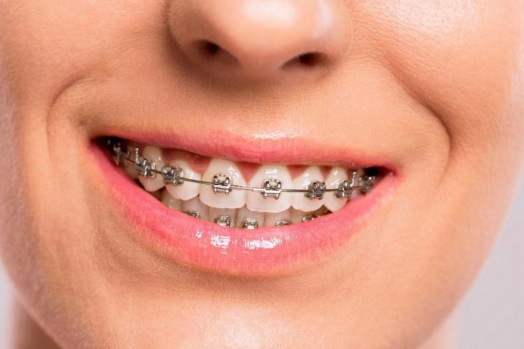 Adults Braces