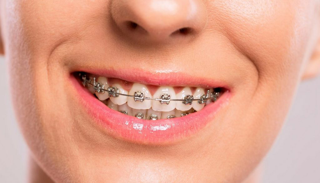 Adults Braces