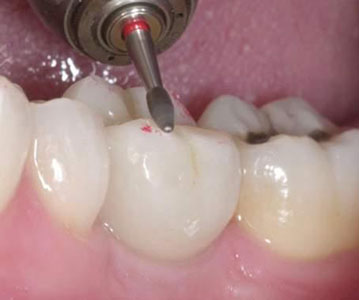 Occlusal Equilibration