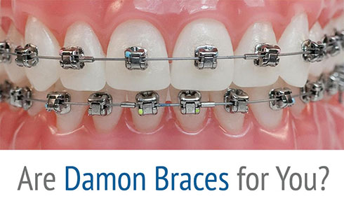 damon braces