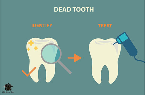 Identifying and treating a dead tooth