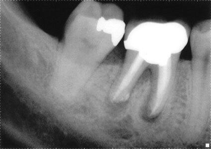 dental abscess